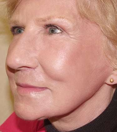 Laser Resurfacing Before & After Patient #136
