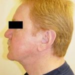 Neck Lift Before & After Patient #275