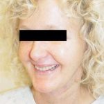 Neck Lift Before & After Patient #278