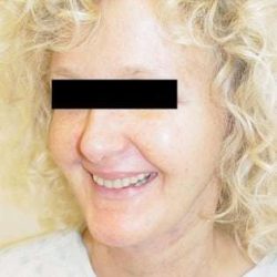 Neck Lift Before & After Patient #278