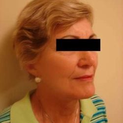 Neck Lift Before & After Patient #281