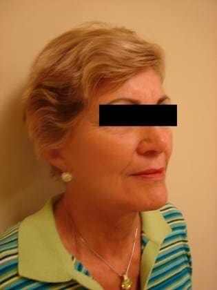 Neck Lift Before & After Patient #281