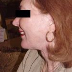 Neck Lift Before & After Patient #284