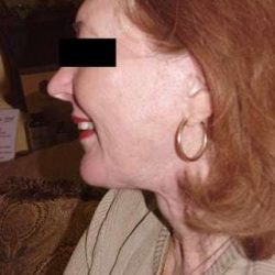 Neck Lift Before & After Patient #284