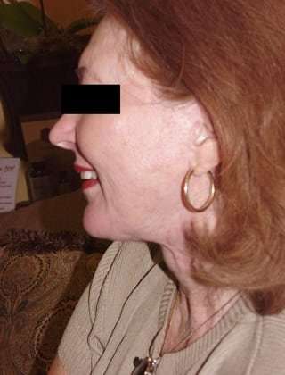 Neck Lift Before & After Patient #284