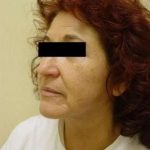 Neck Lift Before & After Patient #287