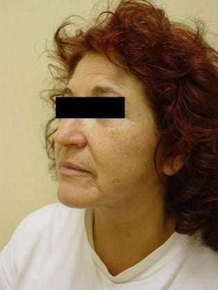 Neck Lift Before & After Patient #287