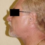 Neck Lift Before & After Patient #290