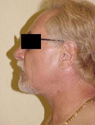 Neck Lift Before & After Patient #290