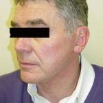 Neck Lift Before & After Patient #293