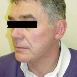 Neck Lift Before & After Patient #293