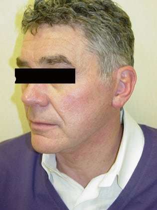 Neck Lift Before & After Patient #293