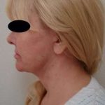 Neck Lift Before & After Patient #296