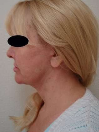 Neck Lift Before & After Patient #296