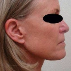 Neck Lift Before & After Patient #299