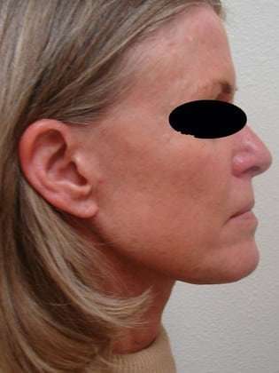 Neck Lift Before & After Patient #299