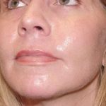 Laser Resurfacing Before & After Patient #139