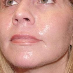 Laser Resurfacing Before & After Patient #139
