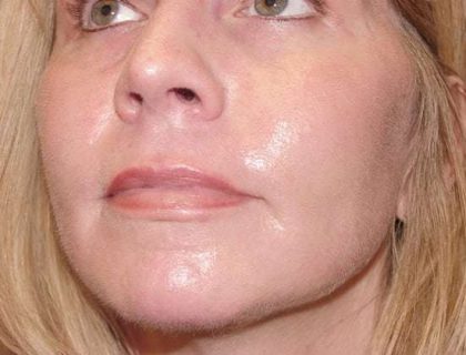 Laser Resurfacing Before & After Patient #139