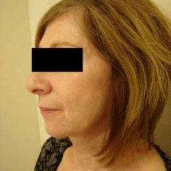 Neck Lift Before & After Patient #302