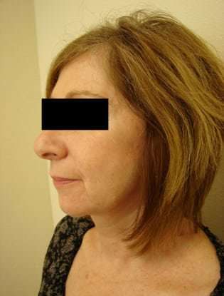 Neck Lift Before & After Patient #302