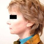 Neck Lift Before & After Patient #306
