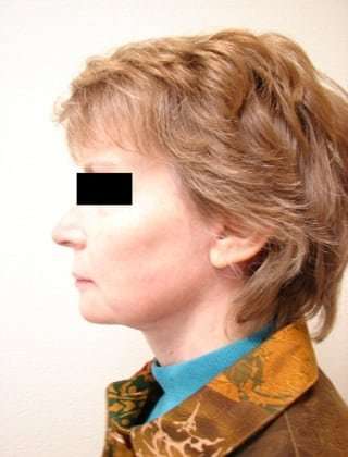 Neck Lift Before & After Patient #306