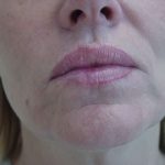 Lip Augmentation Before & After Patient #309