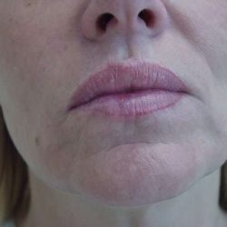 Lip Augmentation Before & After Patient #309