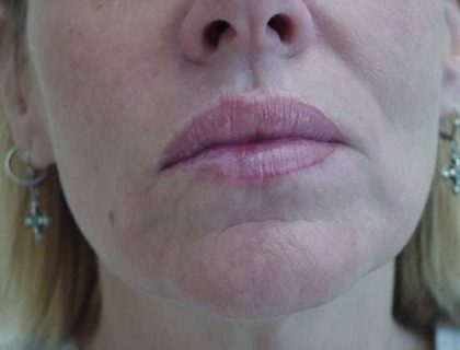 Lip Augmentation Before & After Patient #309
