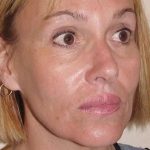 Lip Augmentation Before & After Patient #312