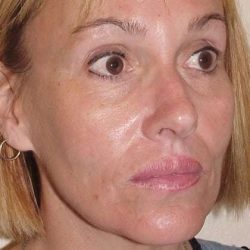Lip Augmentation Before & After Patient #312