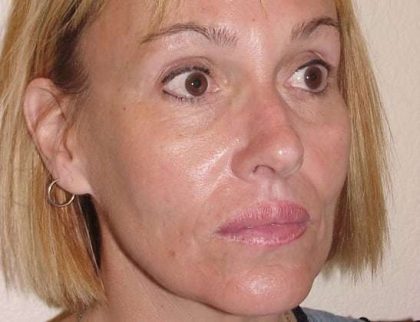 Lip Augmentation Before & After Patient #312