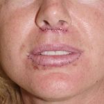 Lip Augmentation Before & After Patient #315