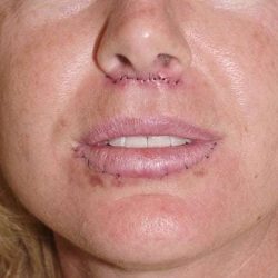 Lip Augmentation Before & After Patient #315
