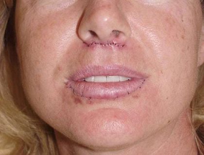 Lip Augmentation Before & After Patient #315