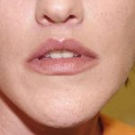 Lip Augmentation Before & After Patient #318