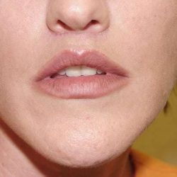 Lip Augmentation Before & After Patient #318