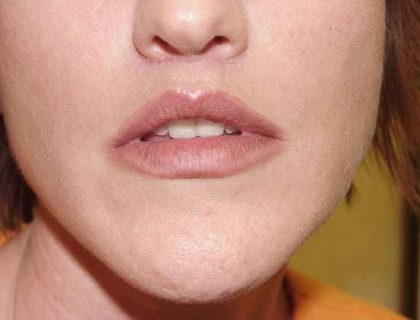 Lip Augmentation Before & After Patient #318