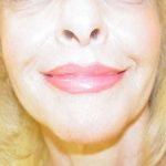 Lip Augmentation Before & After Patient #321