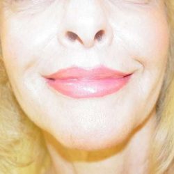 Lip Augmentation Before & After Patient #321