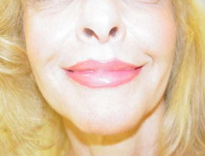 Lip Augmentation Before & After Patient #321