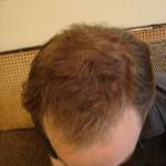 Hair Transplants Before & After Patient #328