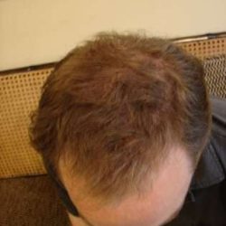 Hair Transplants Before & After Patient #328