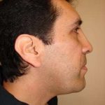 Facial Implants Before & After Patient #333