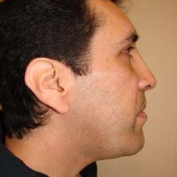 Facial Implants Before & After Patient #333