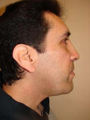 Facial Implants Before & After Patient #333