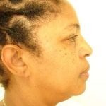 Facial Implants Before & After Patient #343
