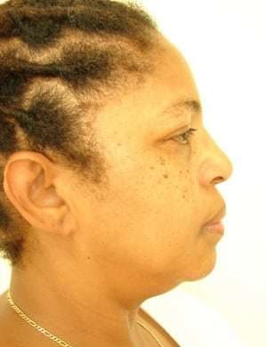 Facial Implants Before & After Patient #343