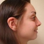 Facial Implants Before & After Patient #346